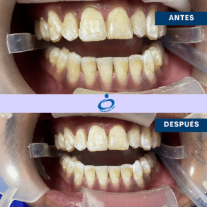Antes y Después de una Blanqueamiento Dental en Protección Oral