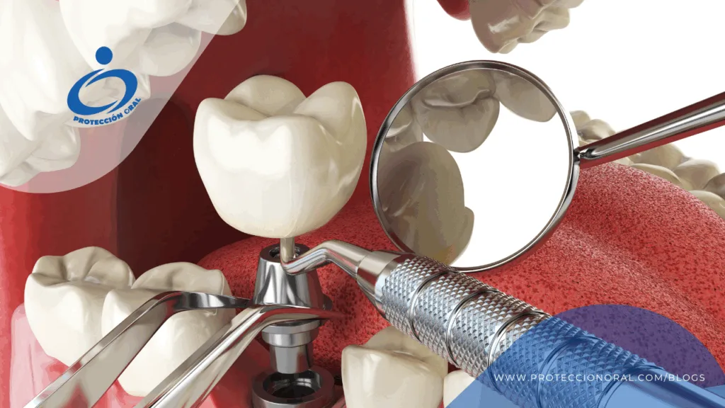 Implantes de carga inmediata. ¿Qué beneficios ofrecen los implantes de carga inmediata?
